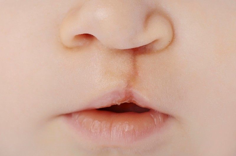 Fissura labiopalatina terá dia anual de conscientização em 24 de junho